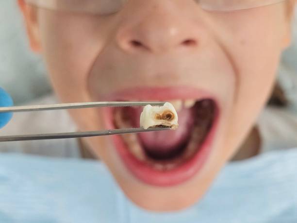 Best Emergency Tooth Extraction in Hope, AR